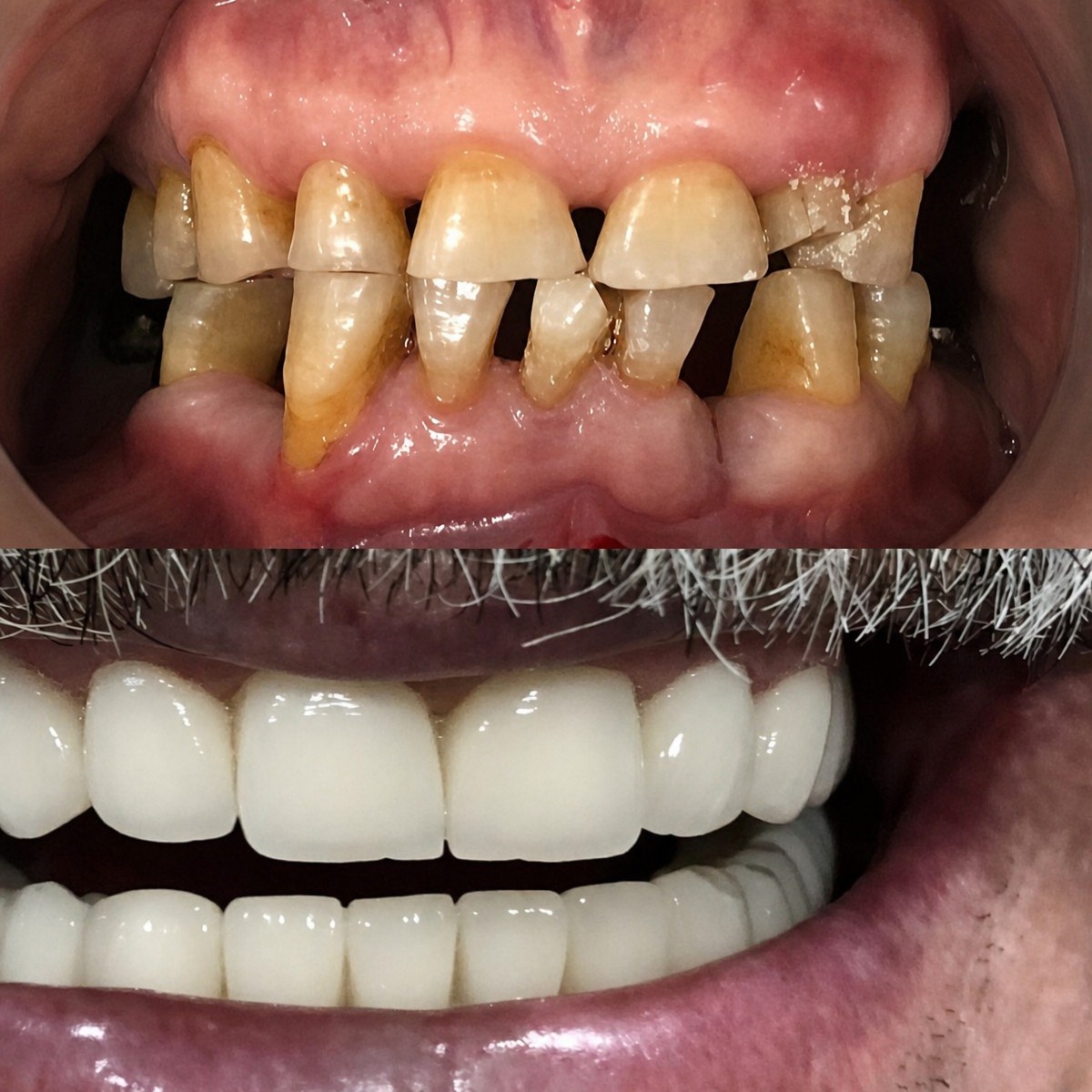 Результаты до и после установки циркониевых коронок в VSC Dental Clinic, восстановление улыбки