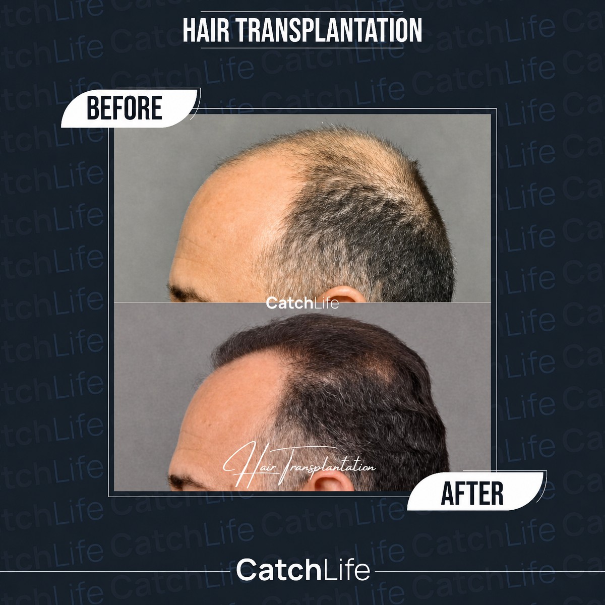 Результати пересадки волосся до і після в CatchLife – відновлена лінія волосся