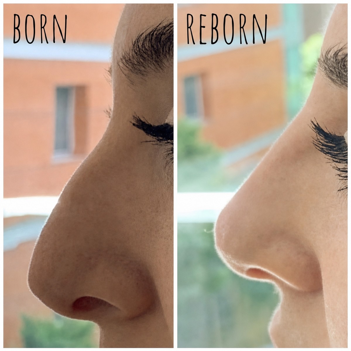 نتيجة قبل وبعد حقن الفيلر في Reborn Clinics، تعديل شكل الأنف بدون جراحة