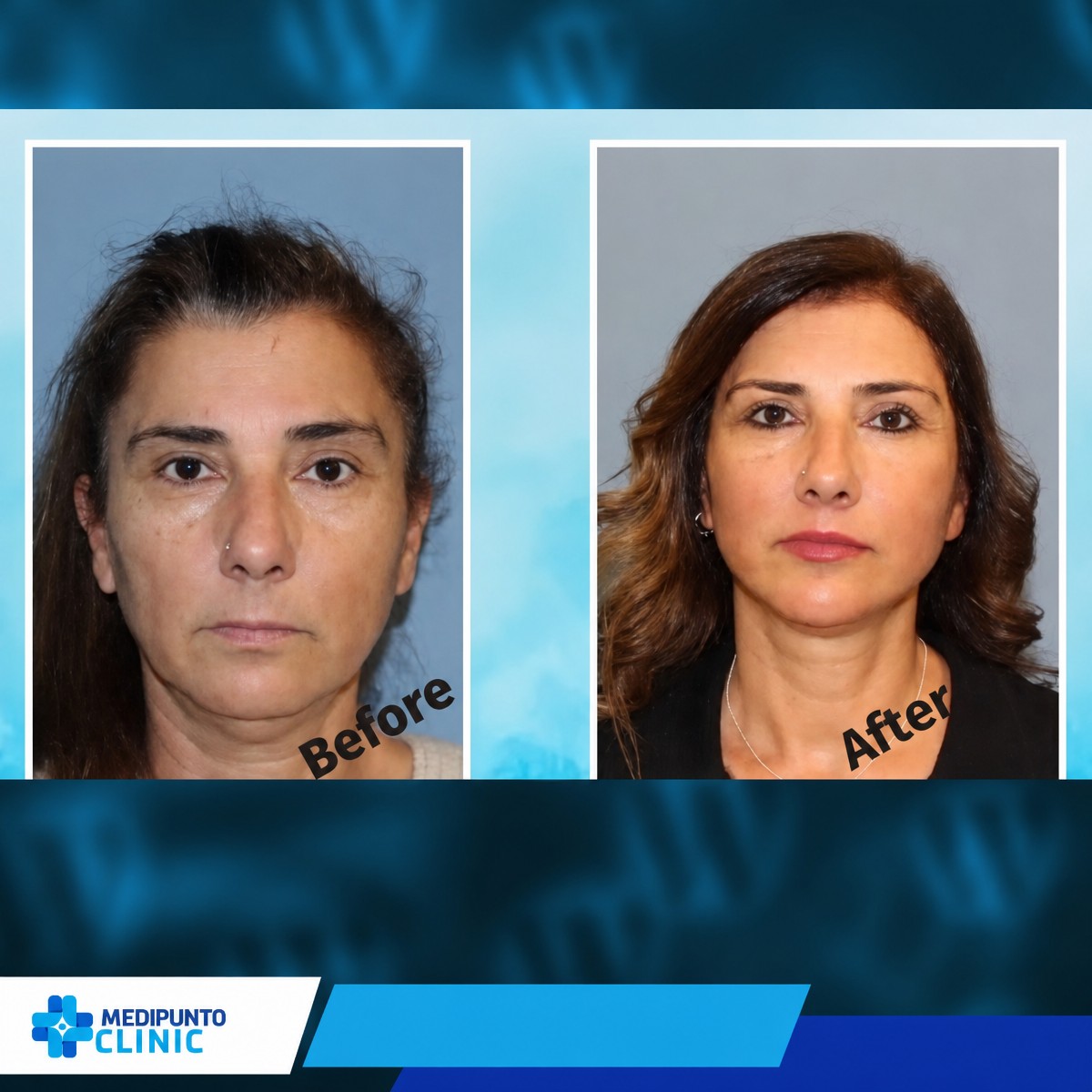 Résultats avant/après mini lifting du visage à la clinique Medipunto, rajeunissement facial