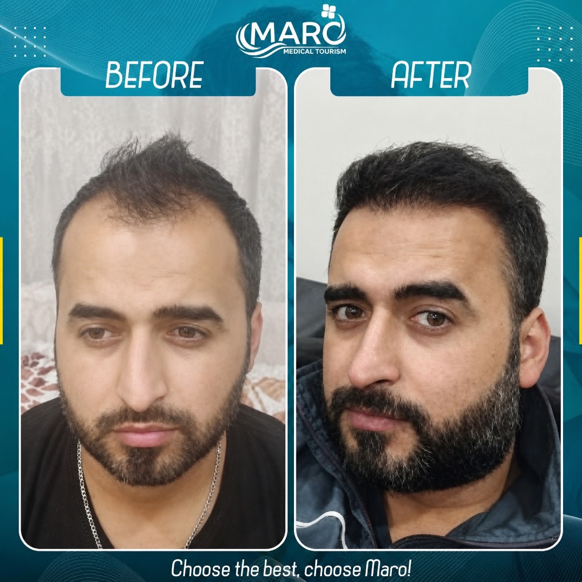 نتائج زراعة الشعر FUE قبل وبعد في عيادة مارو مع خط شعر أكثر كثافة