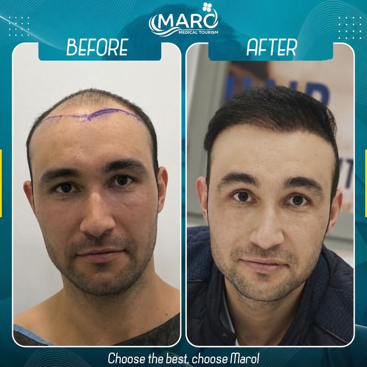 Before and after FUE hair transplant results at Maro Clinic showing restored hairline