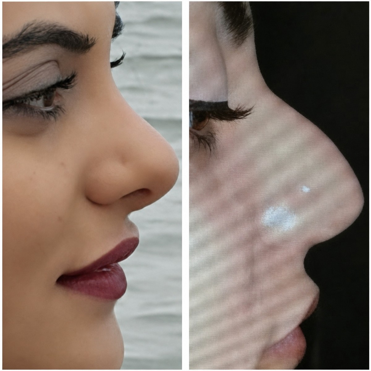 نتائج عملية تجميل الأنف قبل وبعد في Uniqacare Clinic، تحسين شكل الأنف والملف الجانبي