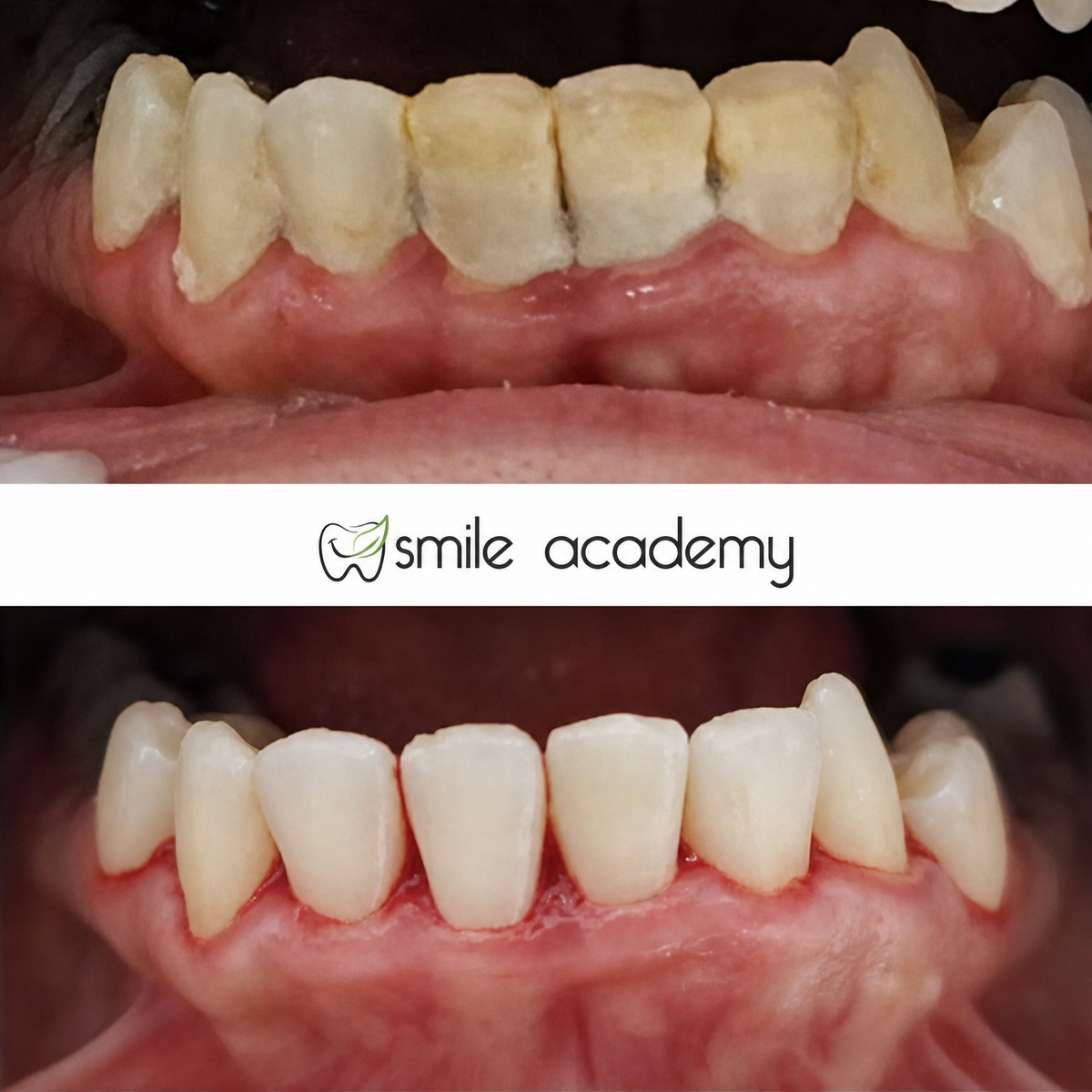 Before and after teeth cleaning (scaling) results at Esthetic Smile Academy, improved smile