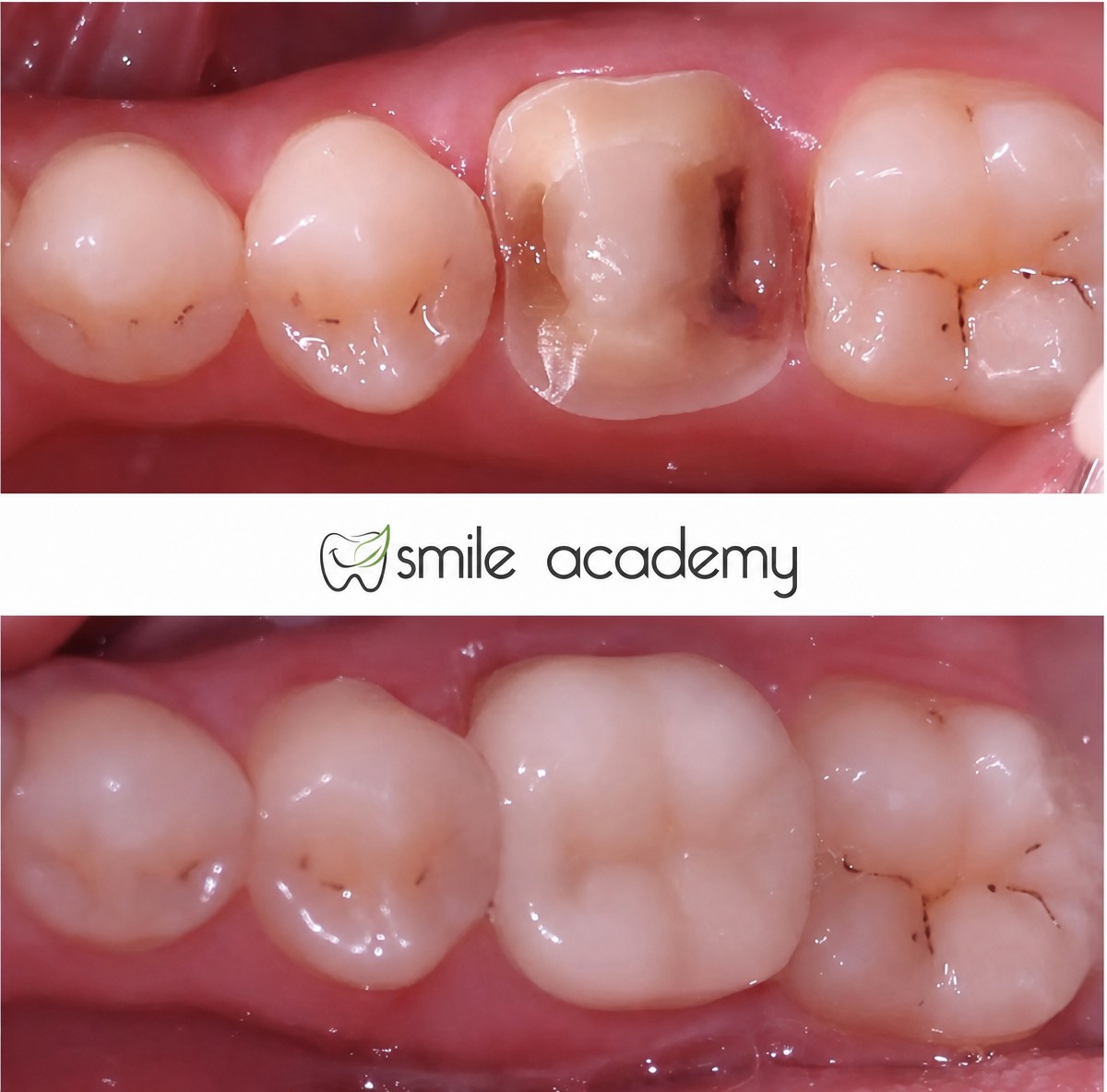 نتائج قبل وبعد عدسات البورسلين في Esthetic Smile Academy، استعادة مظهر الضرس