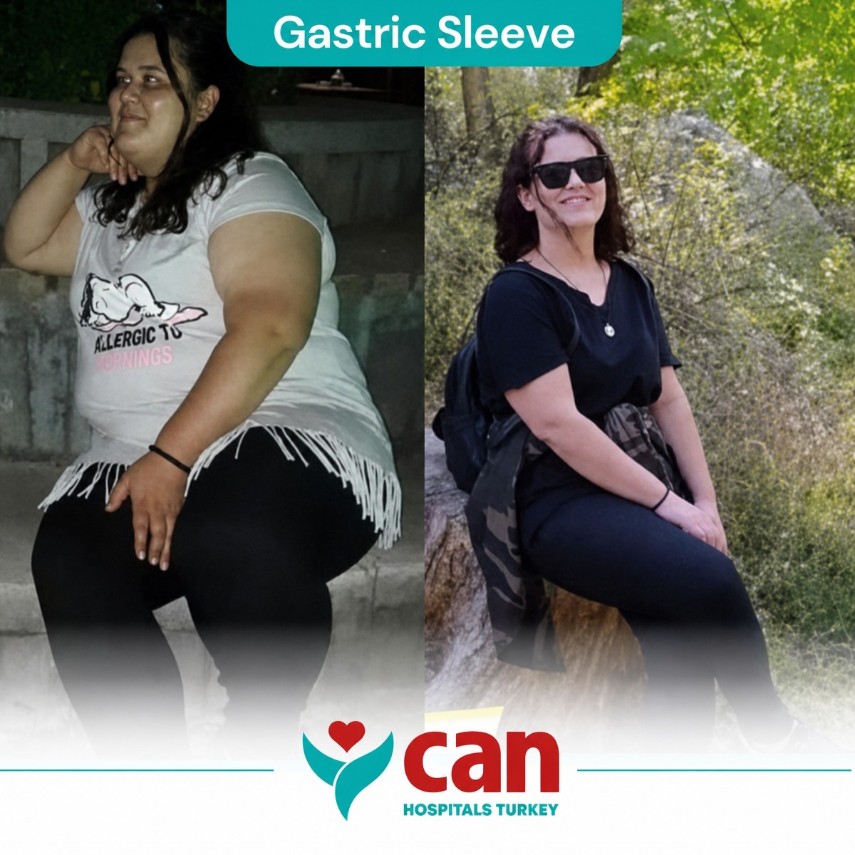 Resultados antes y después de manga gástrica en Can Hospitals Turkey, pérdida de peso visible