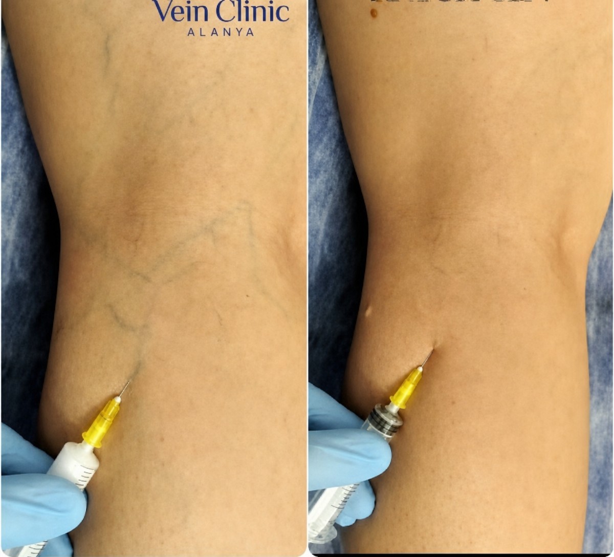 До и после склеротерапии варикозных вен в Vein Clinic Alanya, видимое уменьшение вен