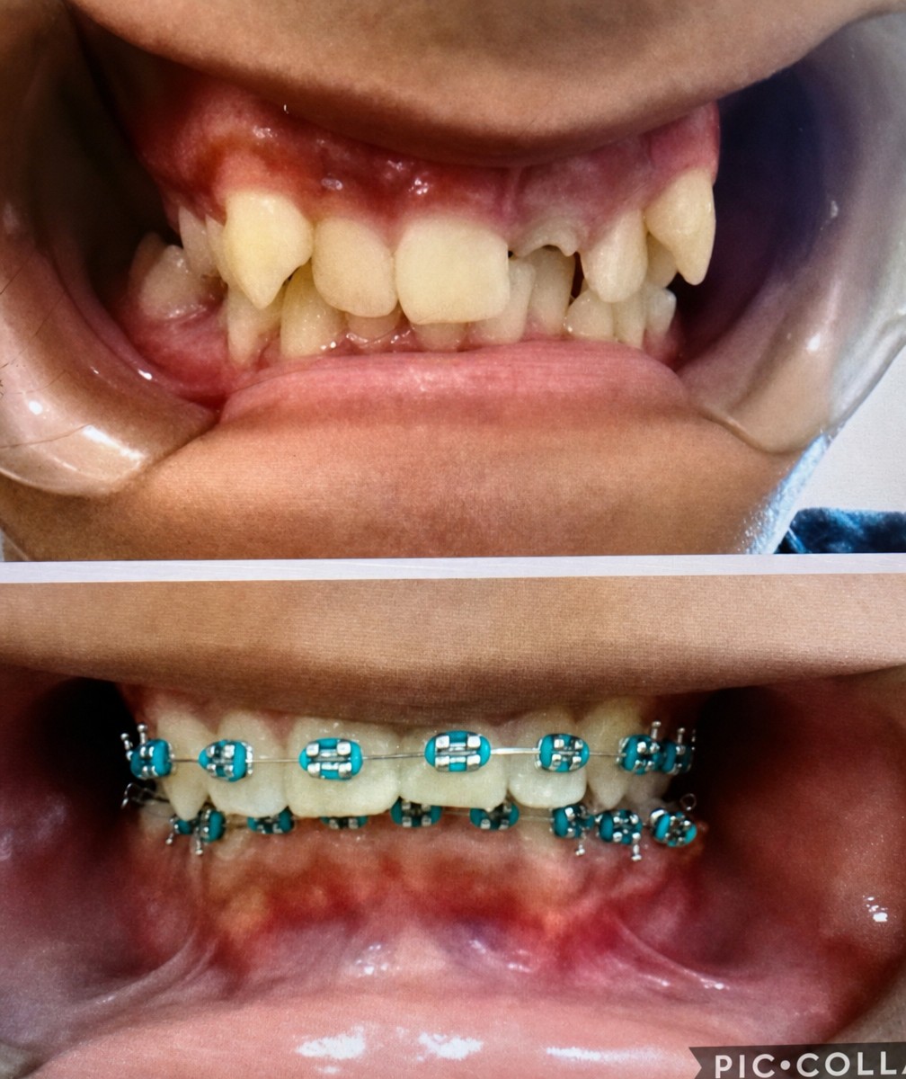 Before and after braces results at Cerro Cancun Clinic, teeth alignment improvement shown