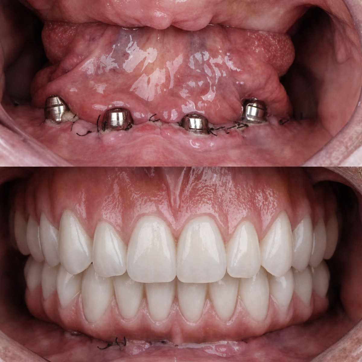 Результаты до и после установки имплантов для Hollywood Smile в My Nova Kusadasi Dental Clinic
