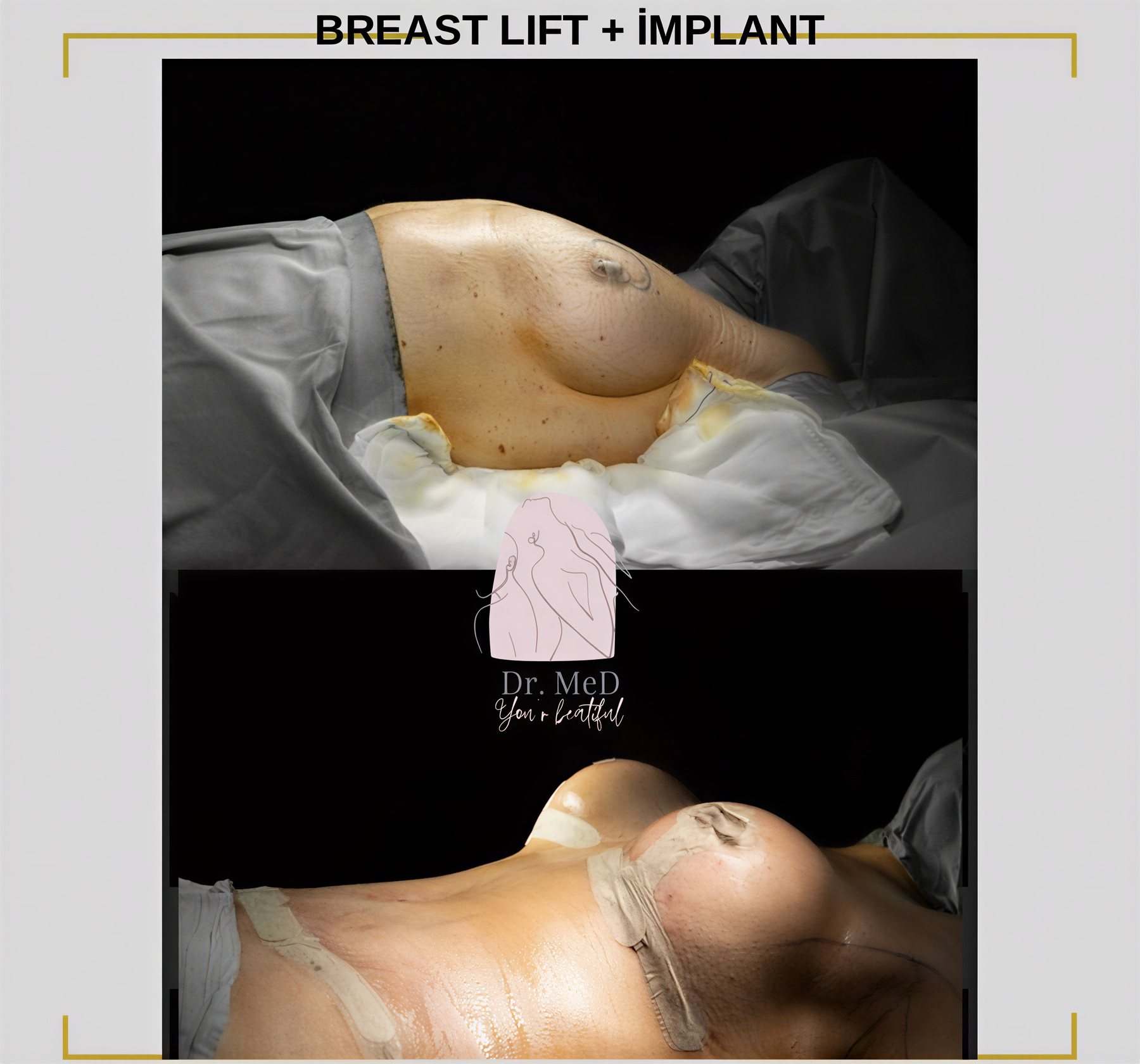 Resultados antes y después de implantes y levantamiento de senos en Dr. MED – contorno mejorado