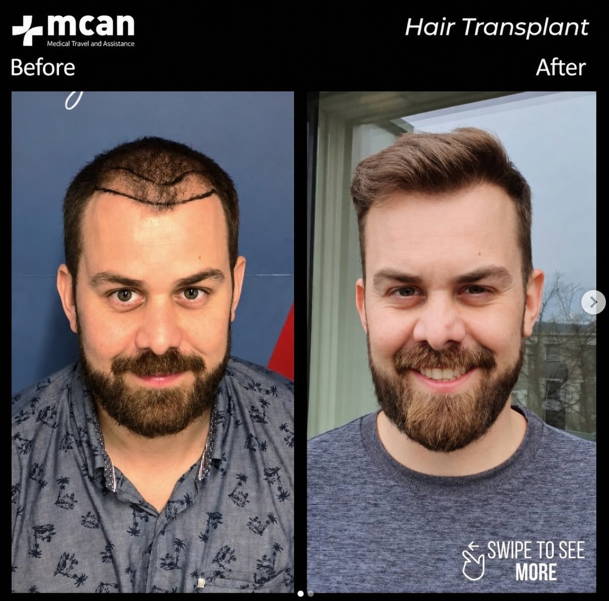 نتيجة زراعة الشعر FUE قبل وبعد في MCAN Health – استعادة خط الشعر للمريض