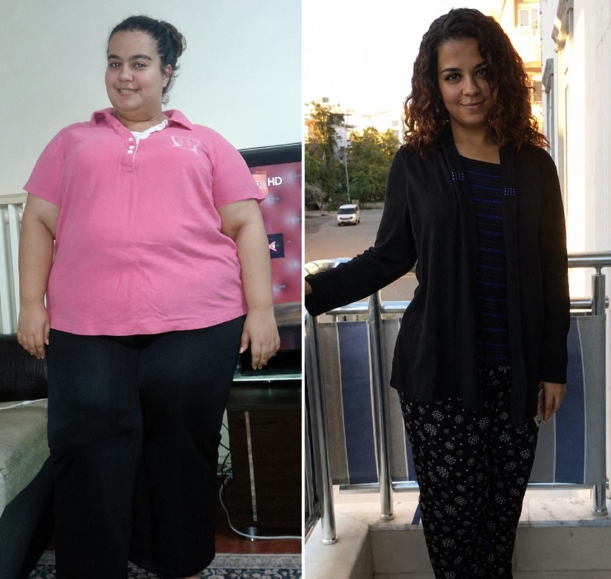 Before and after gastric bypass results at Valued Med Hub Hospitals – significant weight loss