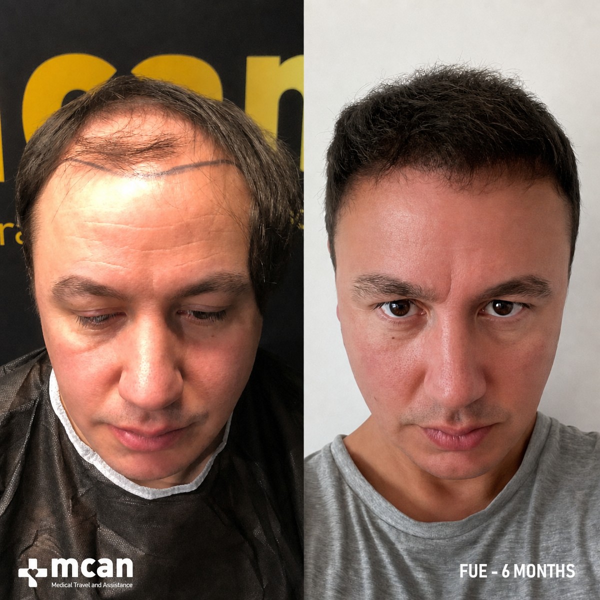 Vorher-nachher-Ergebnis FUE-Haartransplantation bei MCAN Health, sichtbare Haarlinienverbesserung