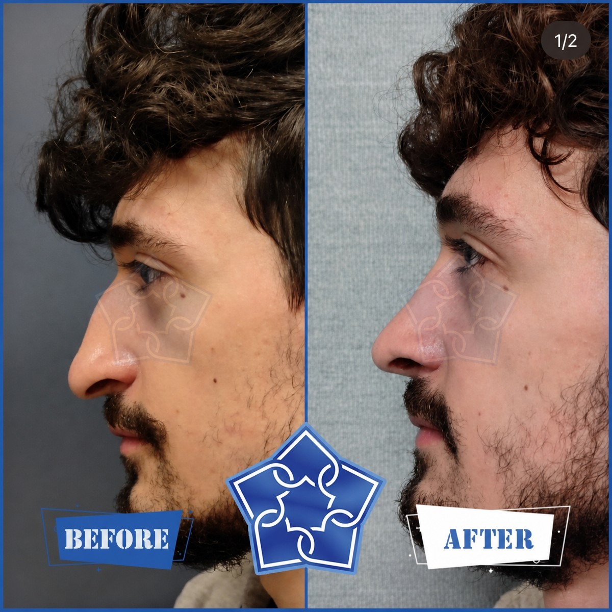 Resultados de rinoplastia antes y después en ERDEM HOSPITAL, mejora de forma y perfil nasal