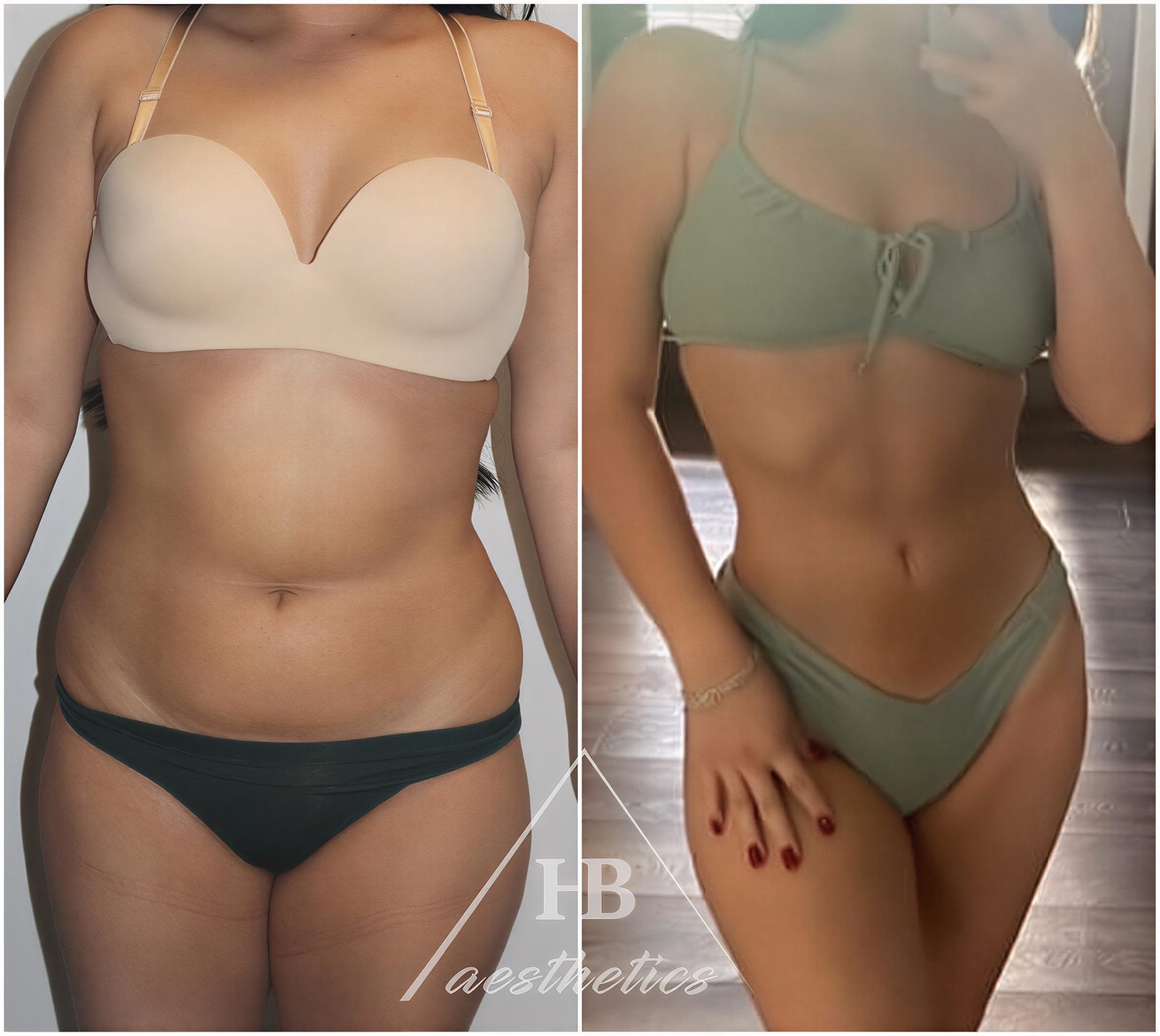 Resultados de liposucción antes y después en Dr. M. Hakan BULAM Aesthetic Plastic Surgery Clinic