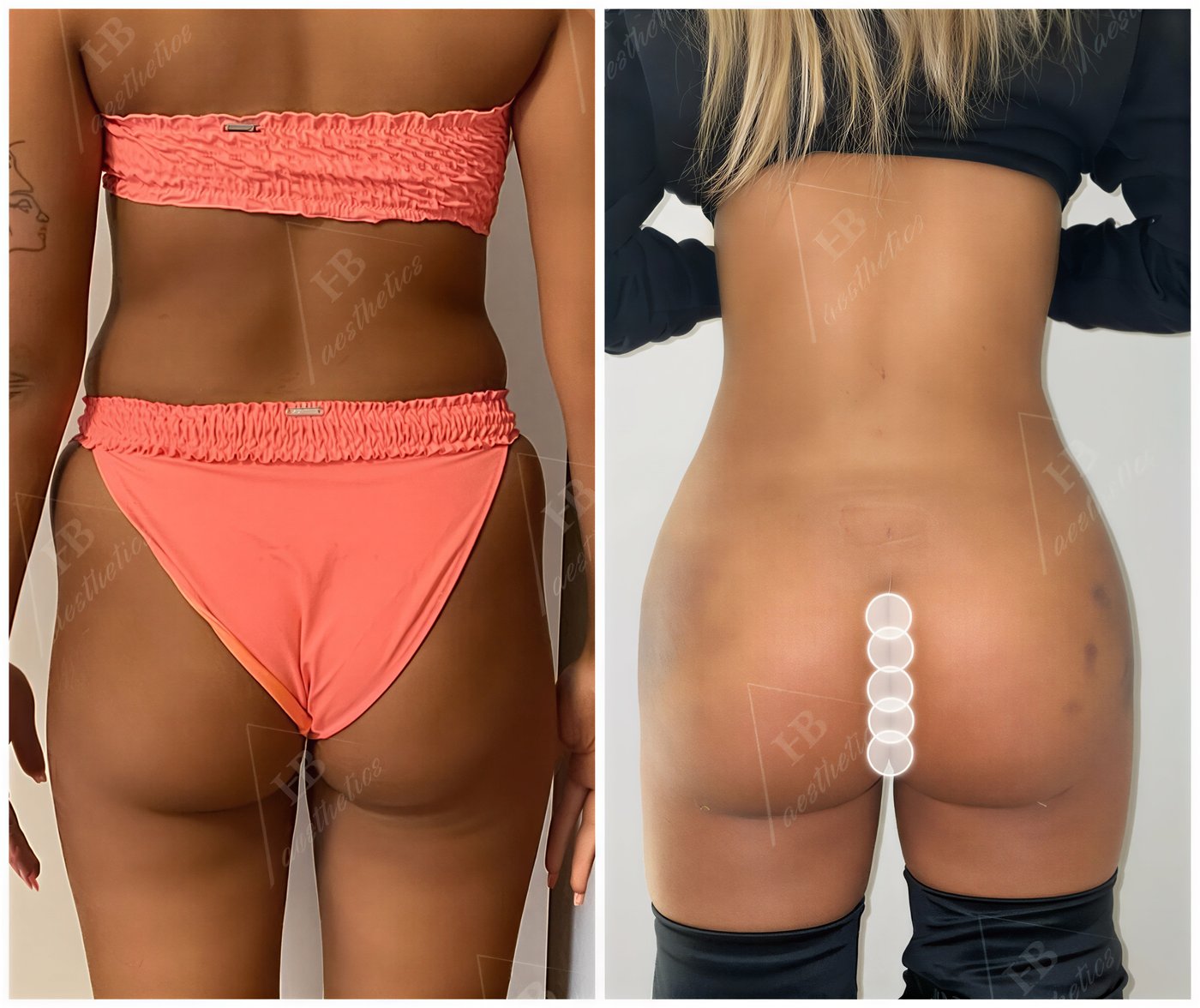 Resultados antes y después de mommy makeover en Dr. M. Hakan BULAM Aesthetic Plastic Surgery Clinic