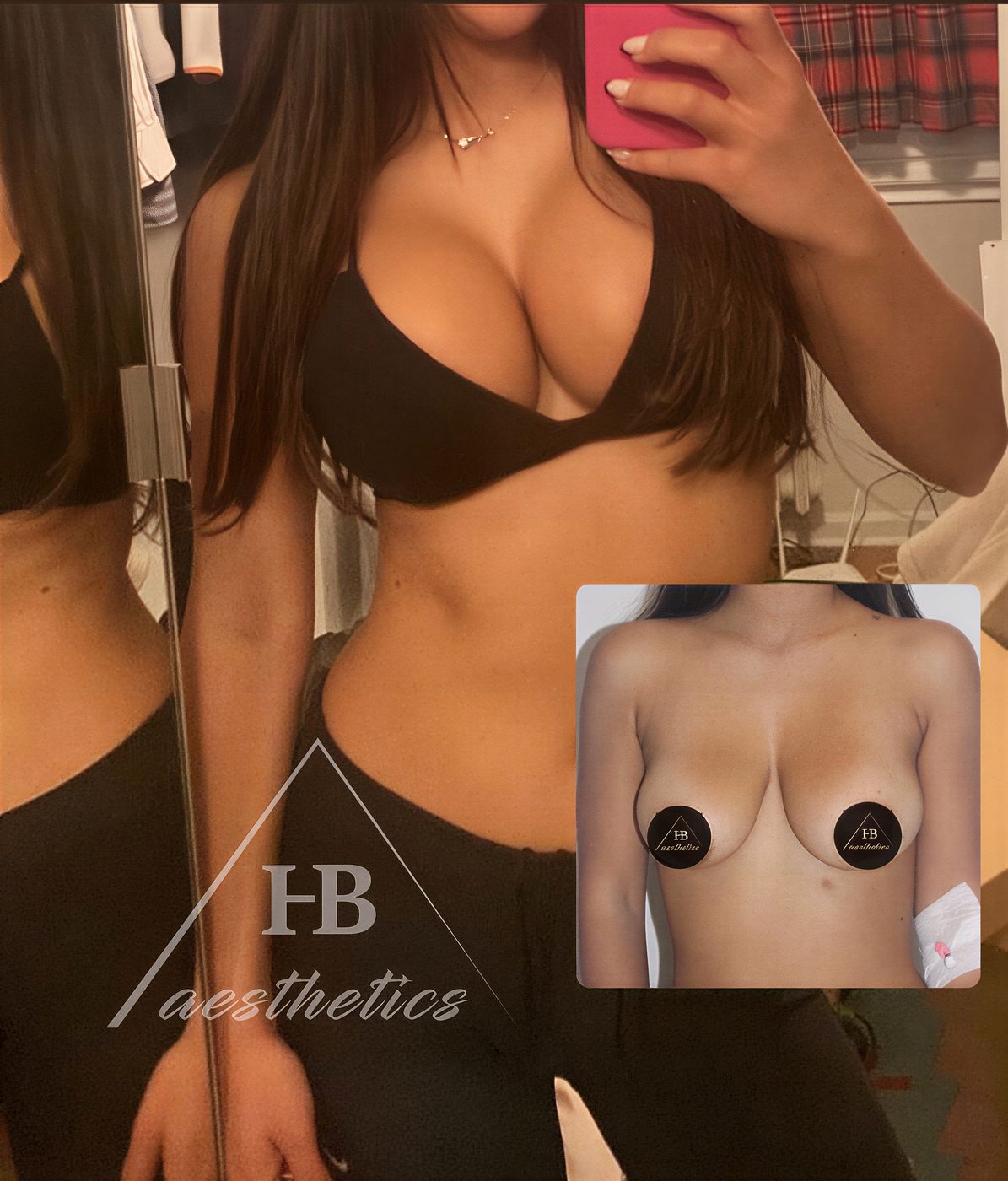 Resultados antes y después de mommy makeover en Dr. M. Hakan BULAM Aesthetic Plastic Surgery Clinic