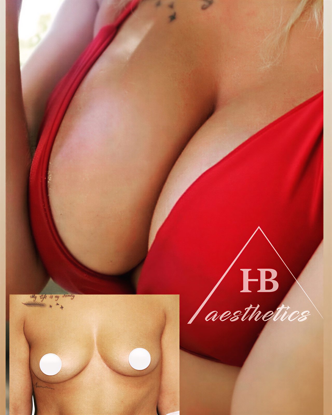Resultados antes y después de aumento de senos en Dr. M. Hakan BULAM Aesthetic Plastic Surgery