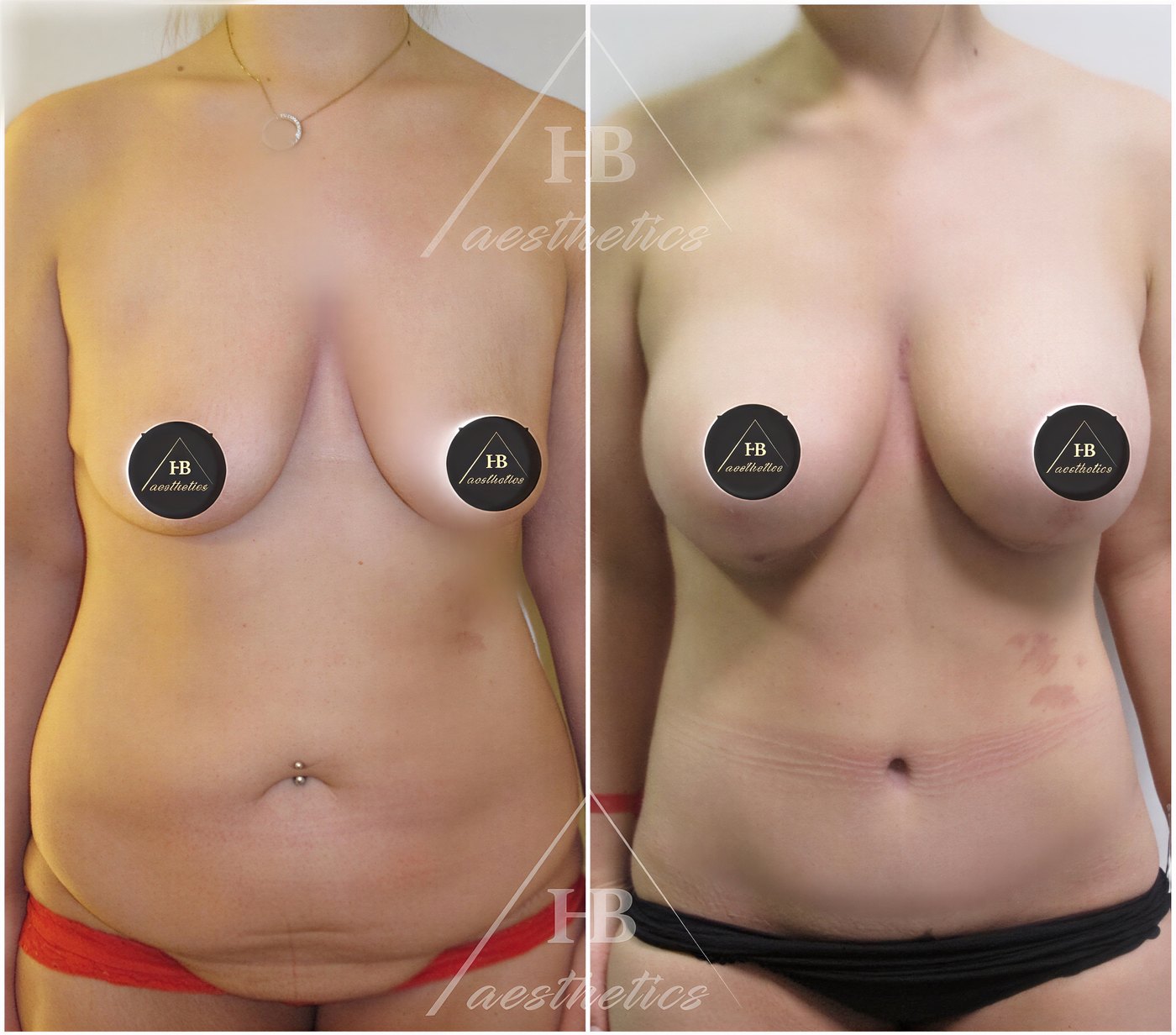 Resultados antes y después de mommy makeover en Dr. M. Hakan BULAM Aesthetic Plastic Surgery Clinic