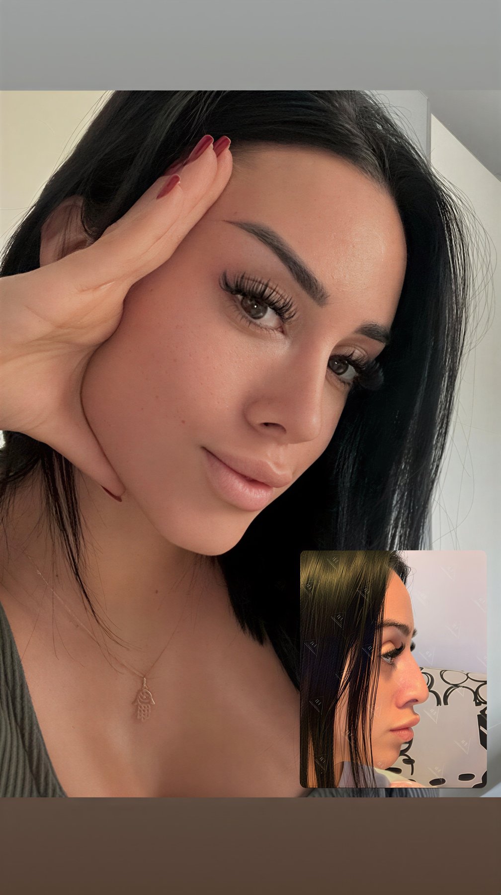 Resultados de rinoplastia antes y después en Dr. M. Hakan BULAM Aesthetic Plastic Surgery Clinic