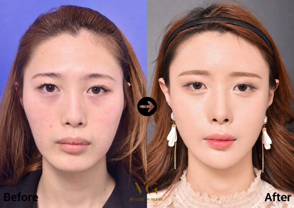 نتائج جراحة تأنيث الوجه قبل وبعد في VG Plastic Surgery، ملامح وجه أكثر نعومة
