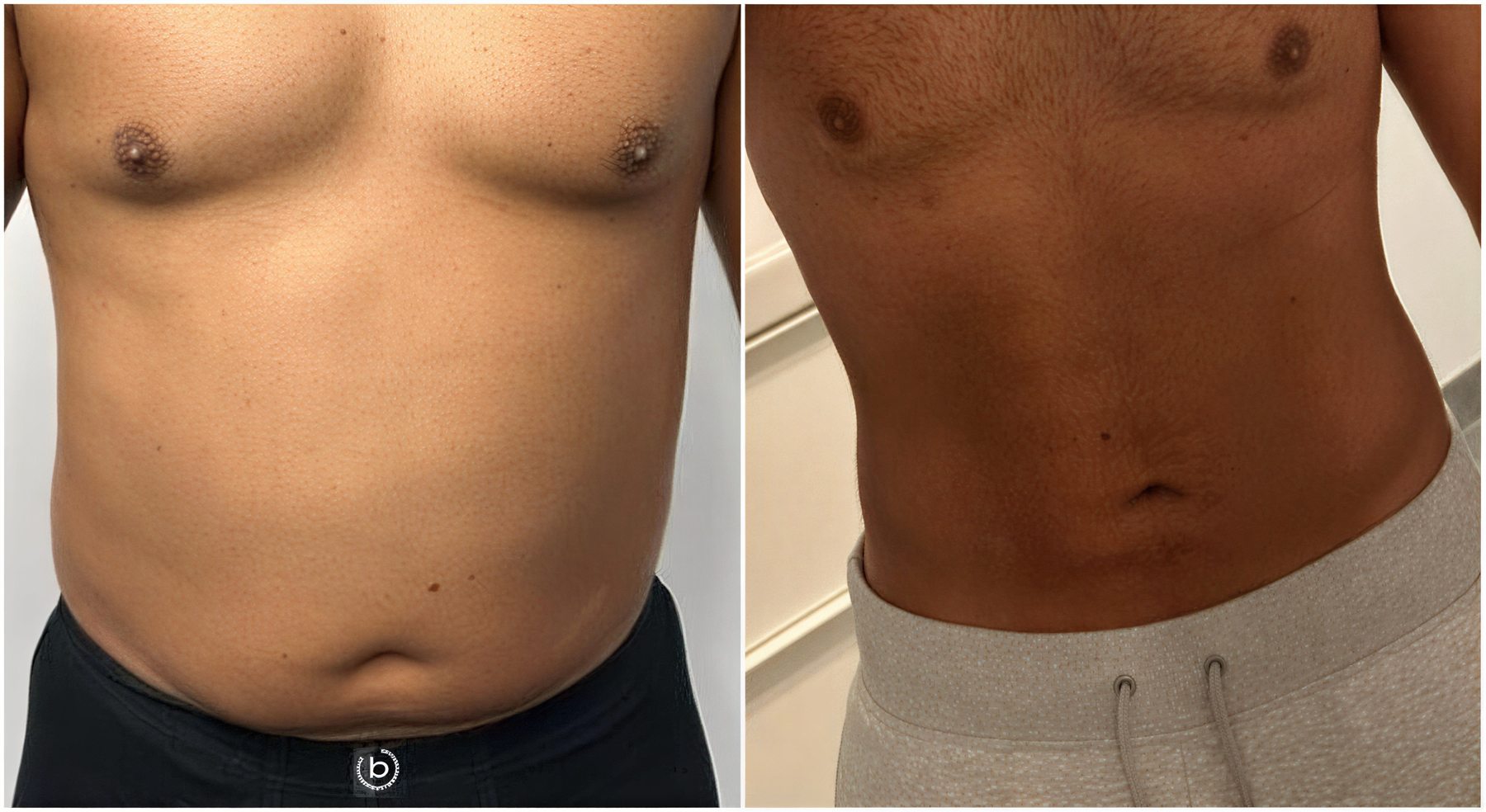 Resultados de liposucción antes y después en Dr. M. Hakan BULAM Aesthetic Plastic Surgery Clinic