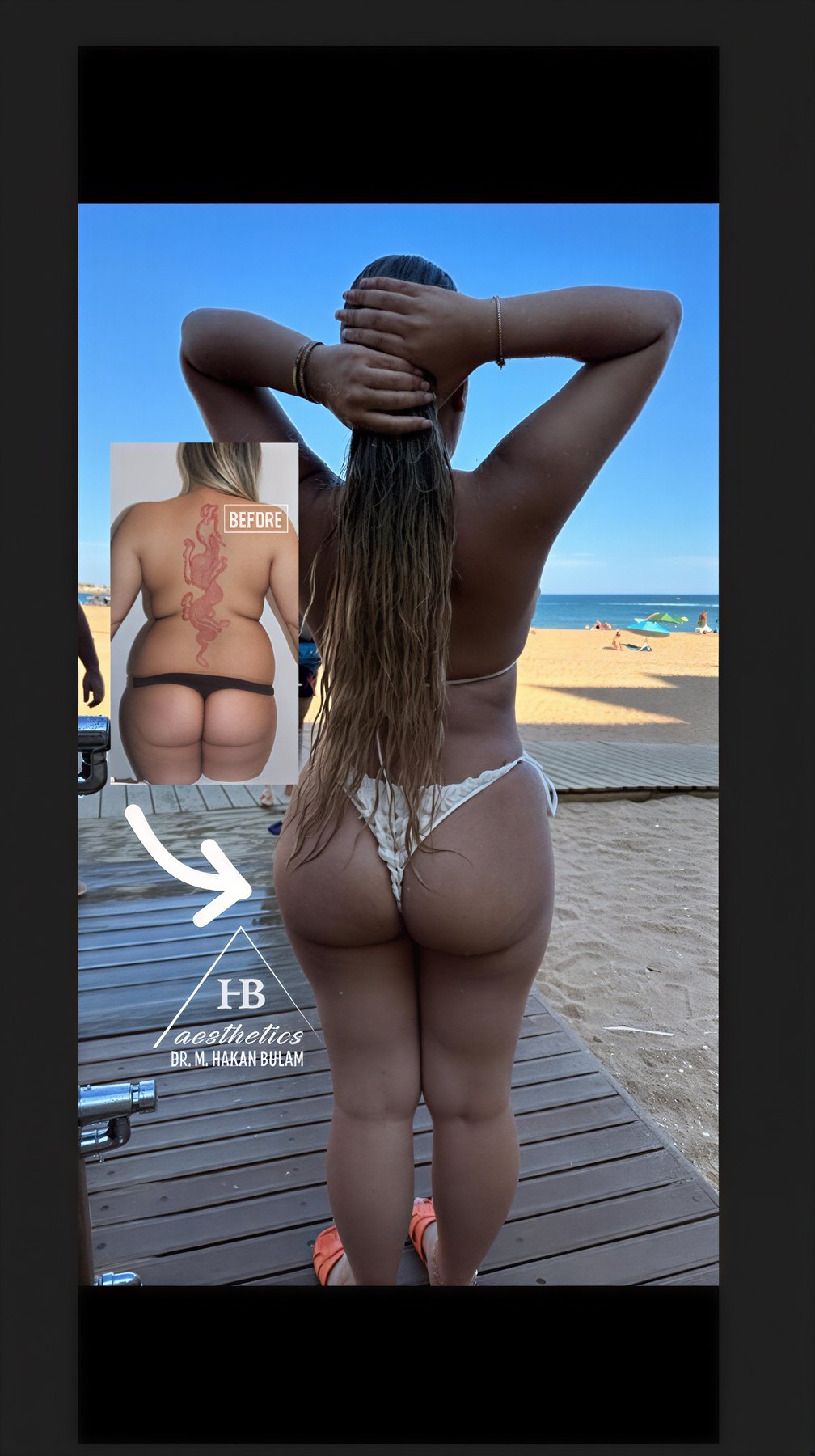 Resultados de liposucción antes y después en Dr. M. Hakan BULAM Aesthetic Plastic Surgery Clinic