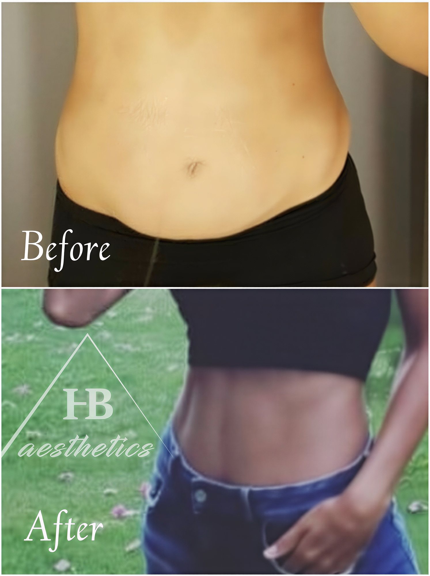 Resultados de mommy makeover antes y después en Dr. M. Hakan BULAM Aesthetic Plastic Surgery Clinic