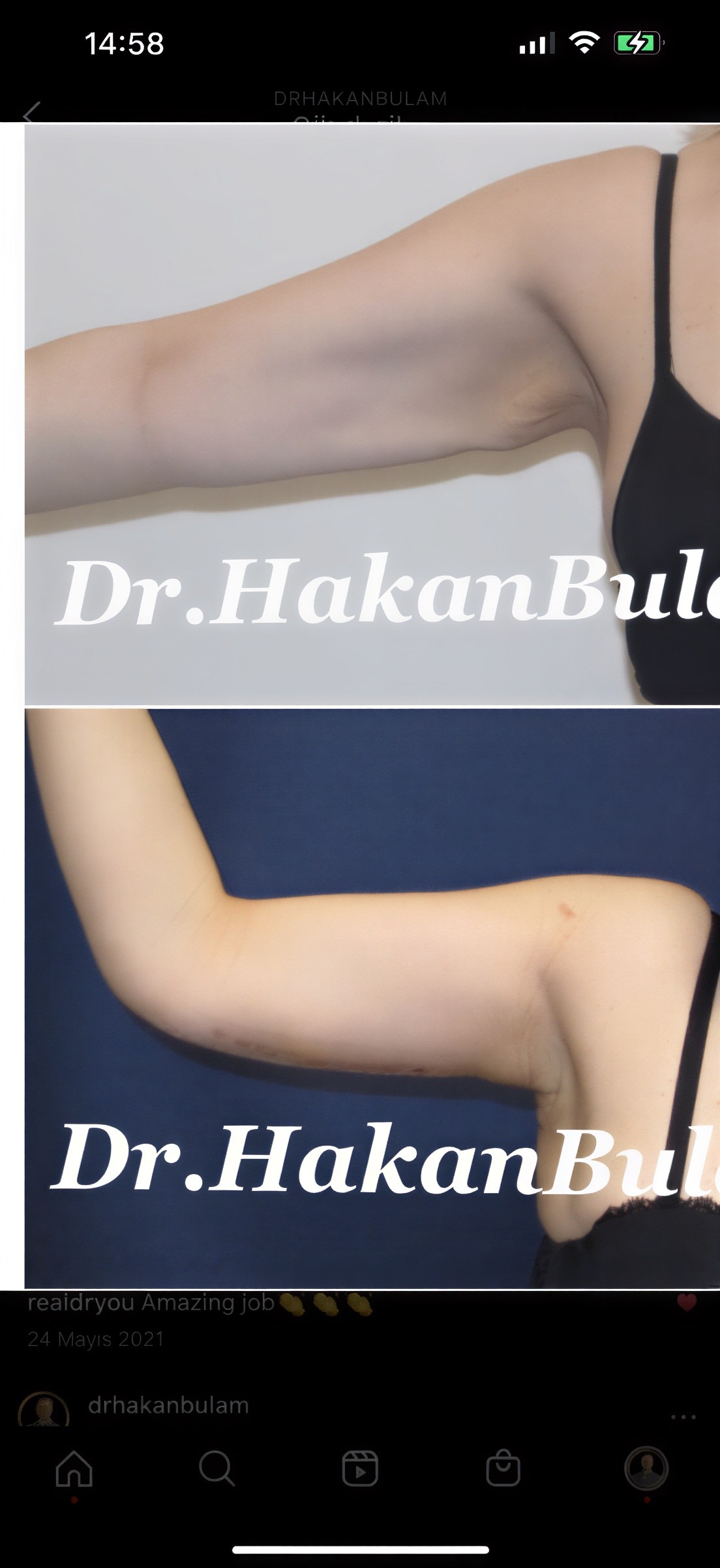 Resultados de liposucción de brazos antes y después en Dr. M. Hakan BULAM Aesthetic Plastic Surgery Clinic