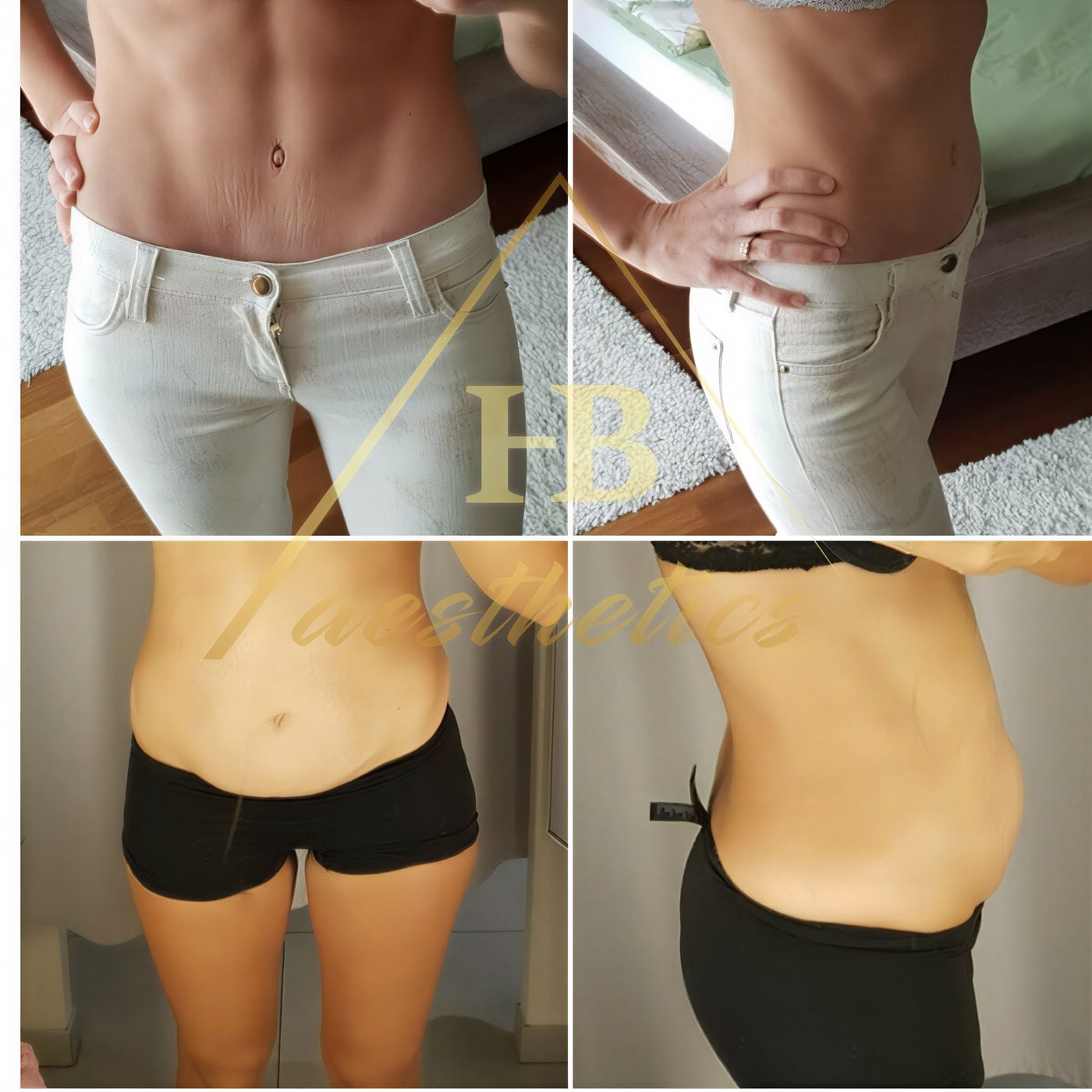 Resultados de abdominoplastia y liposucción antes y después en Dr. M. Hakan BULAM