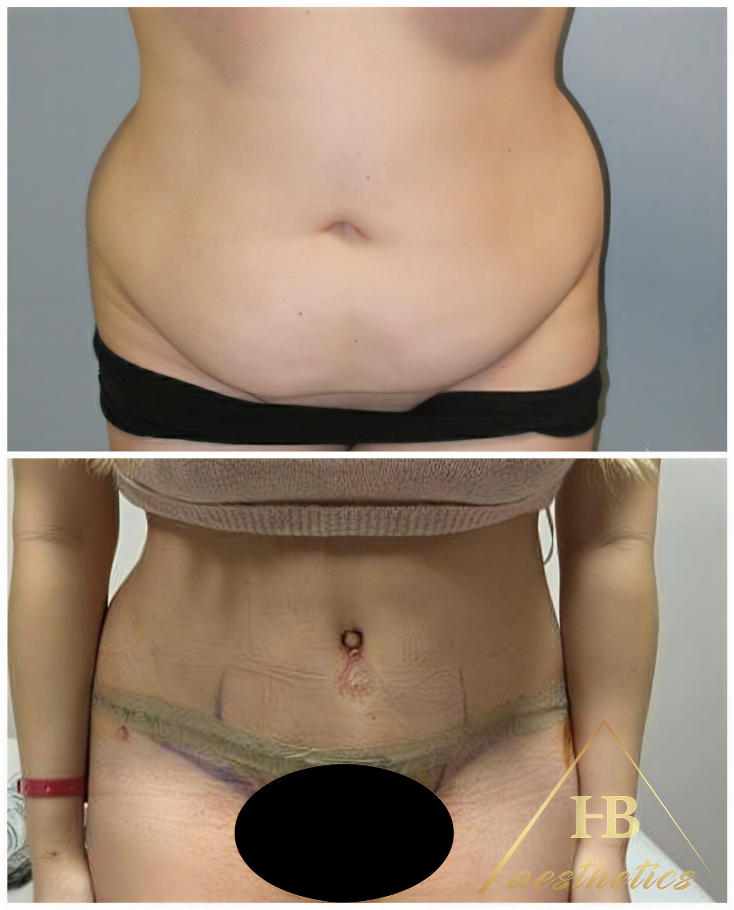 Resultados de abdominoplastia y liposucción antes y después en Dr. M. Hakan BULAM