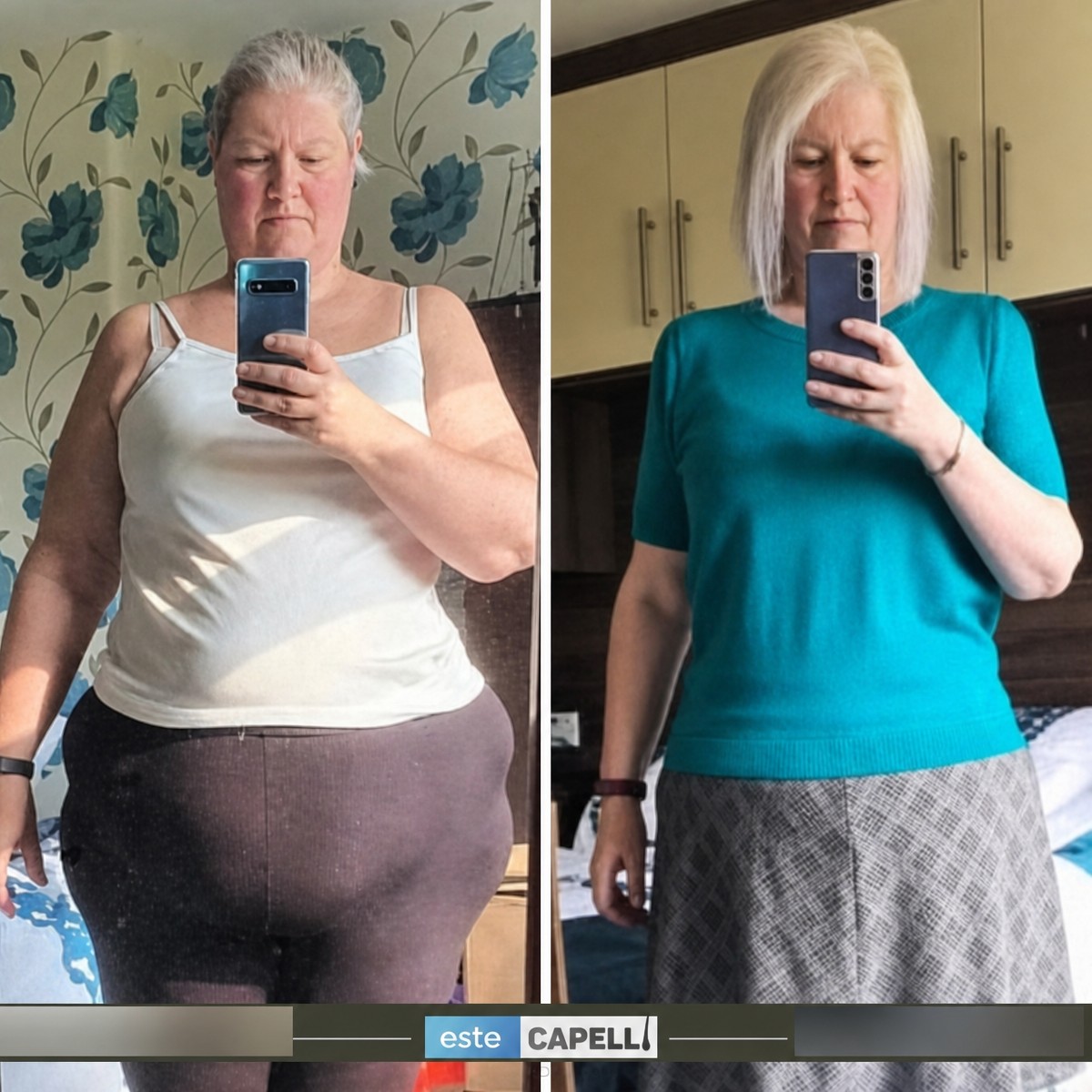 Before and after gastric sleeve surgery results at Istanbul EsteCapelli Clinic Medical Solutions