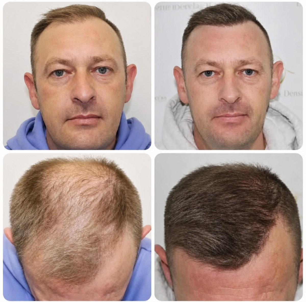 Vorher-nachher-Ergebnis FUE-Haartransplantation bei The Best Hair Clinic, Haaransatz wiederhergestellt