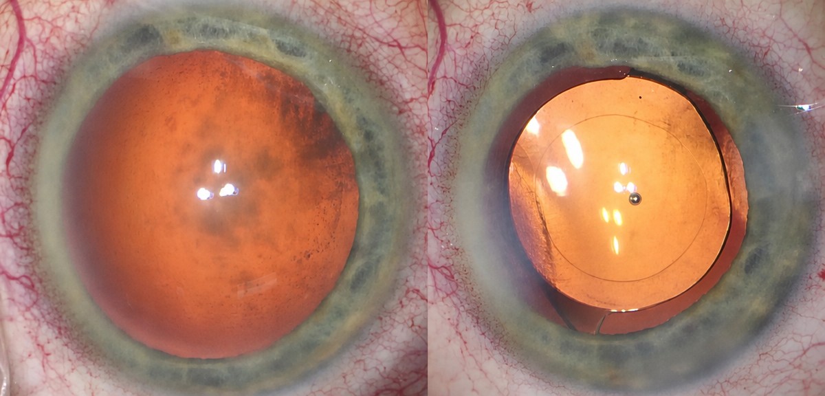 Before and after cataract surgery with IOL replacement result at Dr Nikolaos I Dervenis clinic