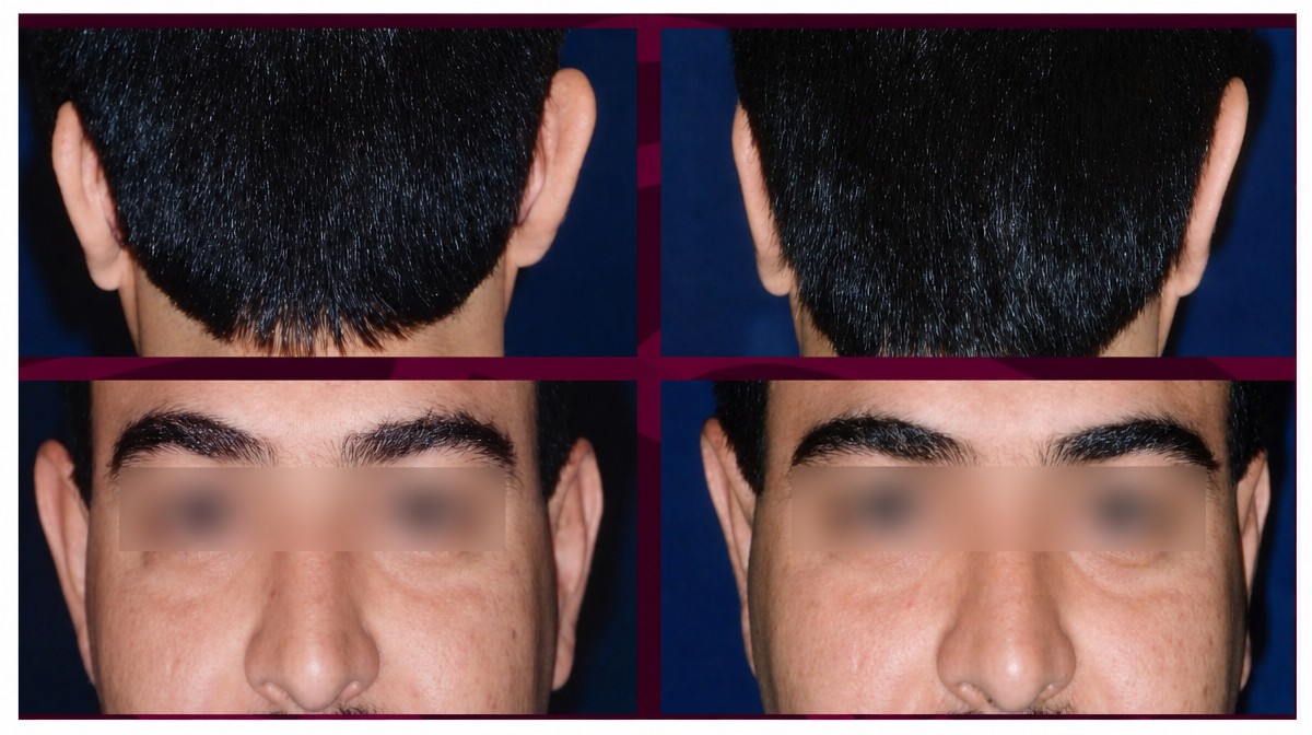 نتائج عملية تجميل الأذن قبل وبعد في عيادة بويبلا لجراحة الجلد والتجميل، إعادة تشكيل الأذن