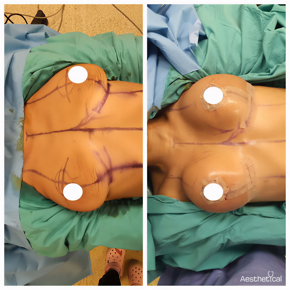 Resultados de lifting de senos antes y después en Aesthetical Clinic, mejor contorno