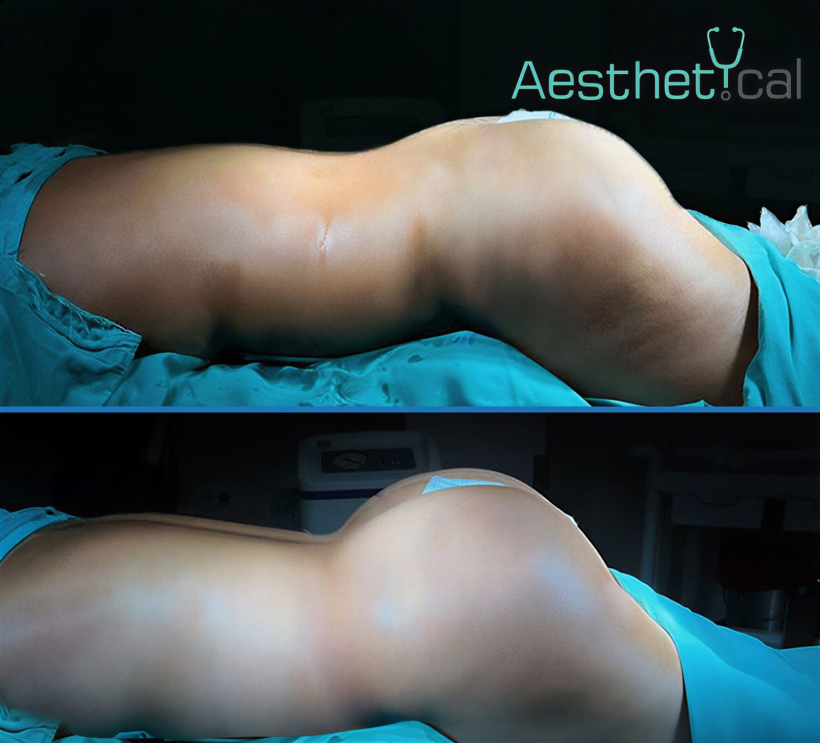 Resultados antes y después de Brazilian Butt Lift en Aesthetical Clinic, glúteos realzados
