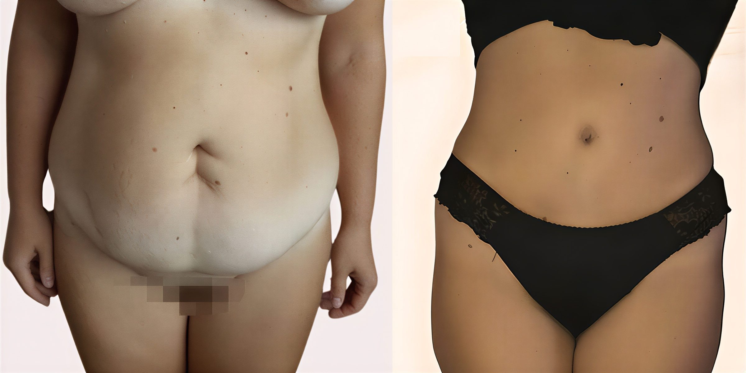 نتائج شد البطن قبل وبعد في مركز Dievo Surgery – تحسين واضح لشكل البطن