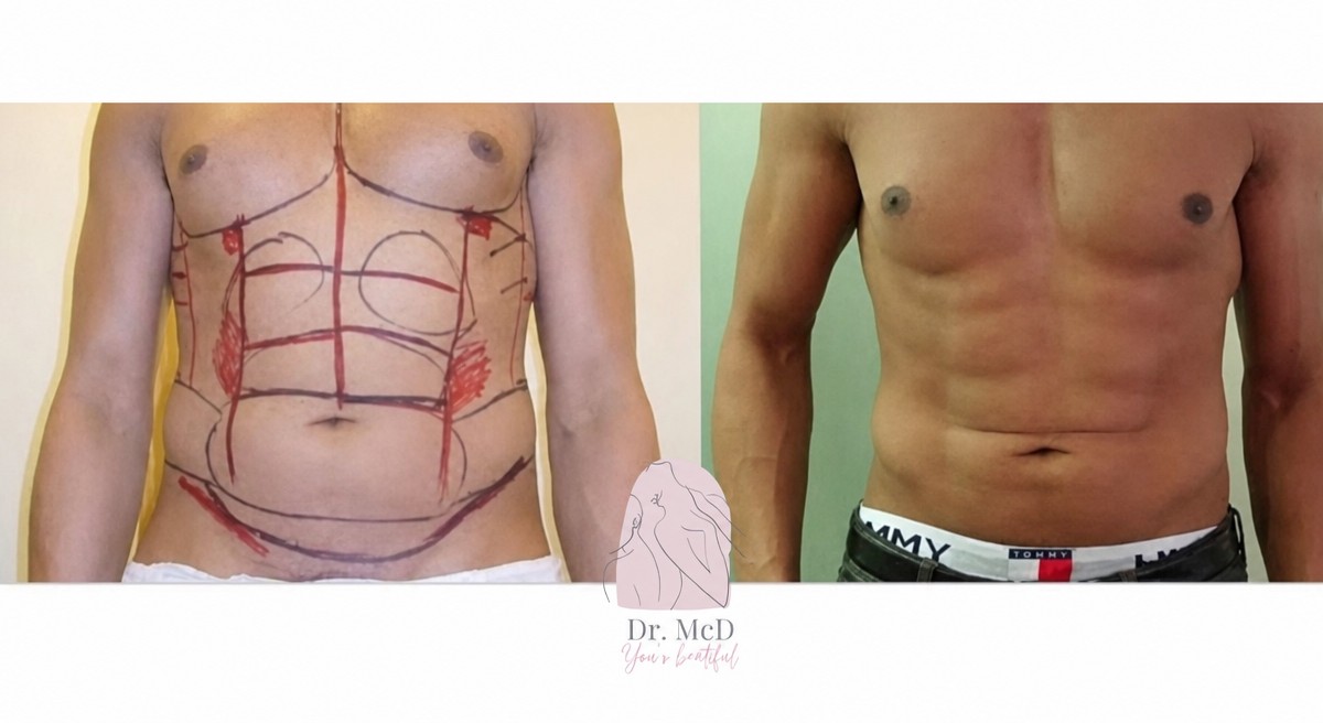 Before and after abdominal etching results at Dr. MED – defined six pack abs transformation