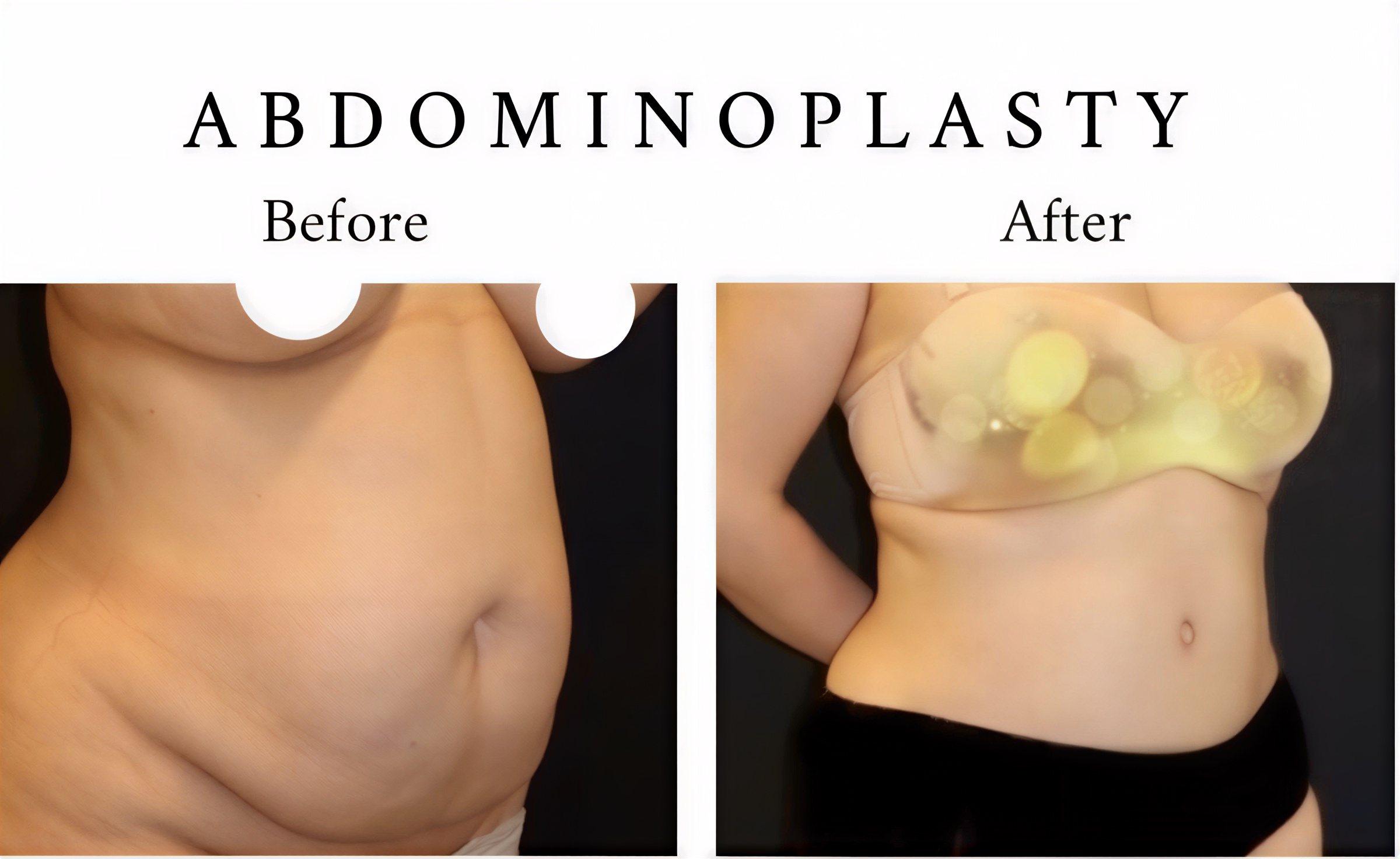 Resultados de abdominoplastia antes y después en Avangart Dental Clinic, contorno visible