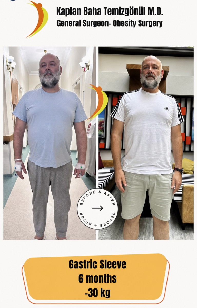Résultats avant/après sleeve gastrectomie à Lotus Bariatrics Clinic, -30kg en 6 mois