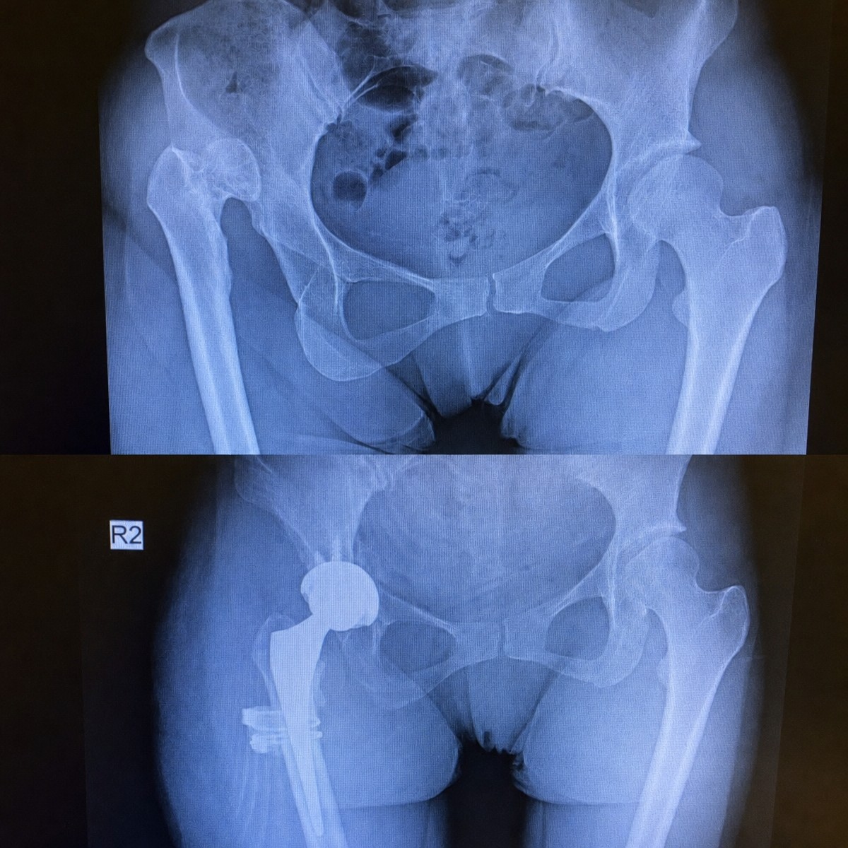 Before and after MAKOplasty hip replacement results at Private Medicabil Hospital, improved joint
