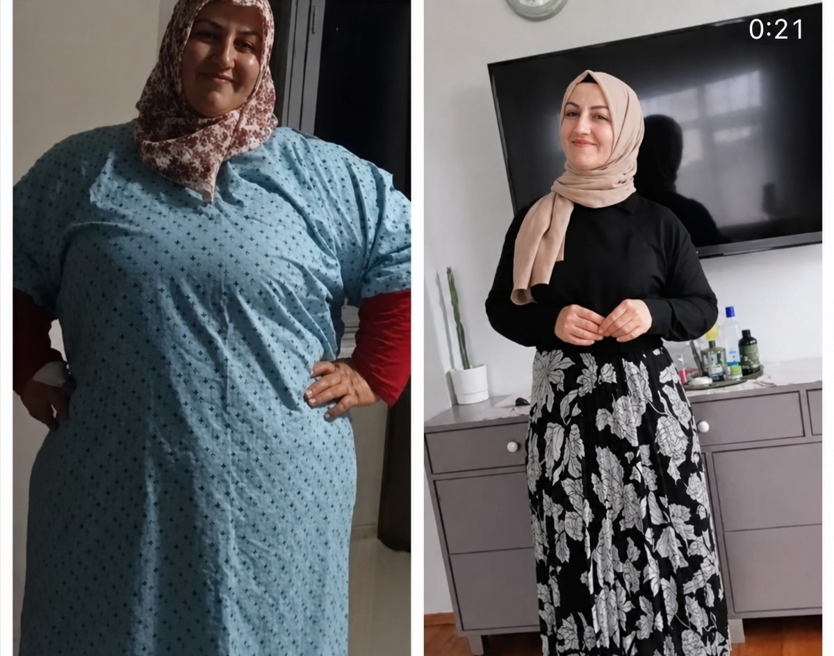 Before and after gastric sleeve surgery results at Private Medicabil Hospital, visible weight loss