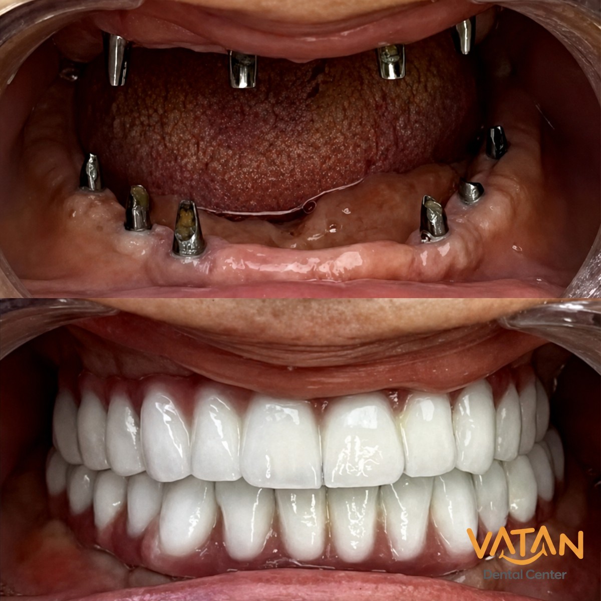 Результат до и после установки All-on-6 в VATAN DENTAL CENTER, полное восстановление улыбки