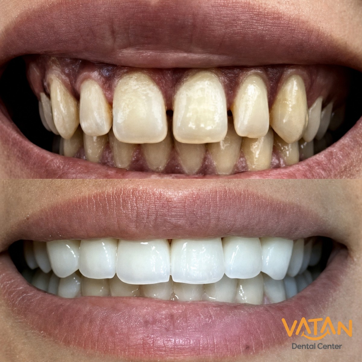 До и после виниров Hollywood Smile в VATAN DENTAL CENTER, видимый результат преображения улыбки