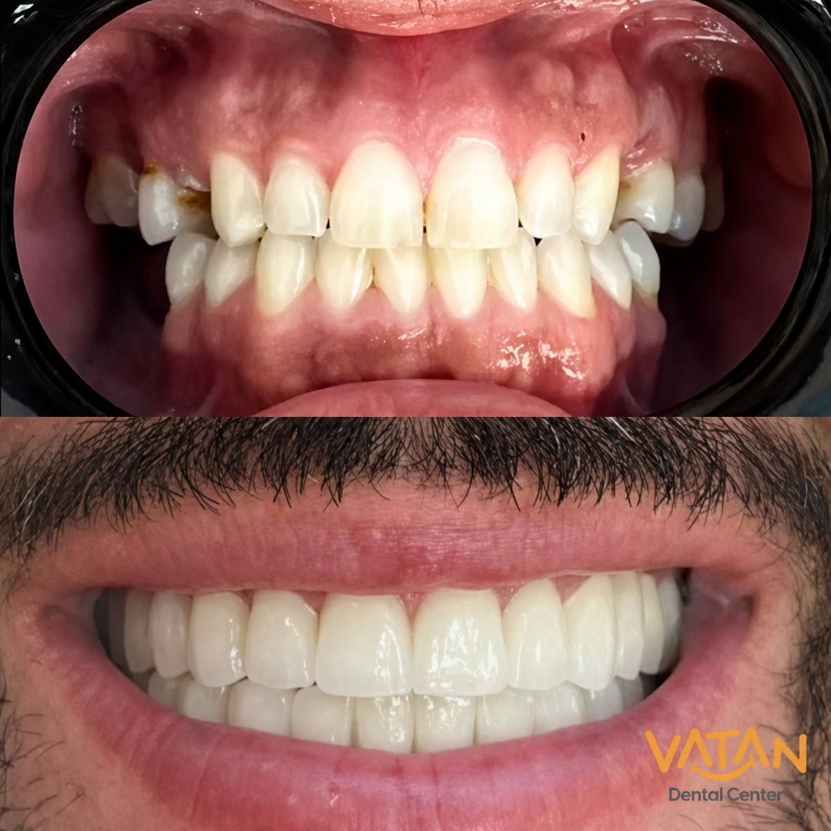 Resultados de antes y después de Hollywood Smile en VATAN DENTAL CENTER, transformación con carillas