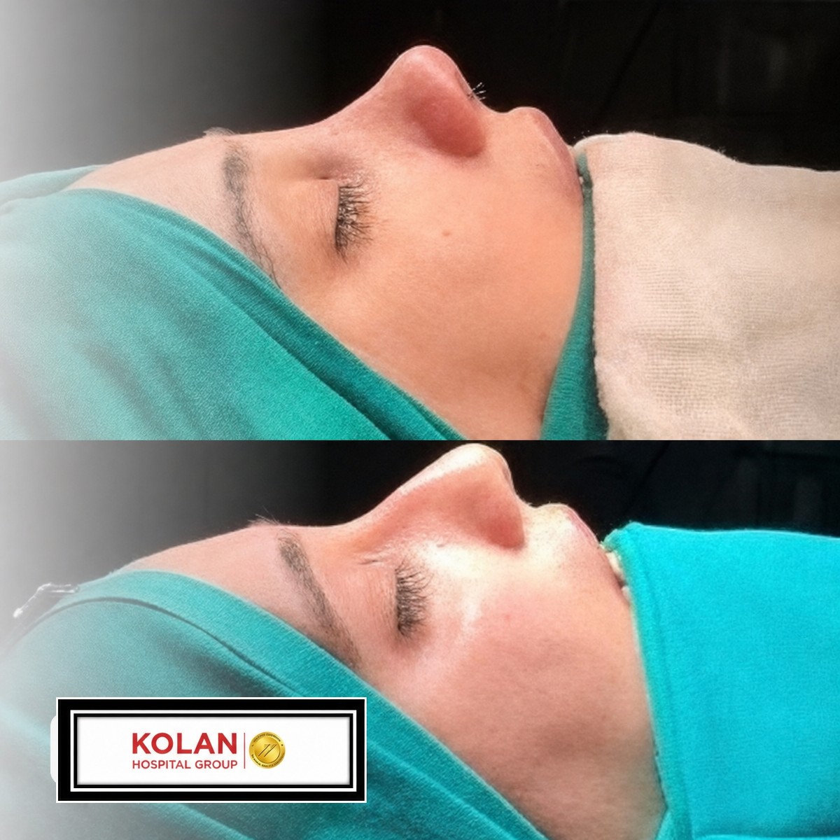 Before and after rhinoplasty results at Kolan Hospital Group, improved nose profile