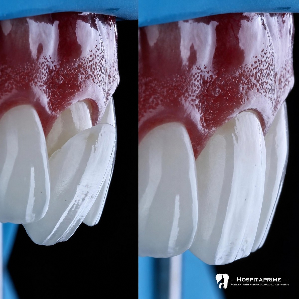 Before and after veneers at Hospitaprime Clinic, improved tooth shape and color result