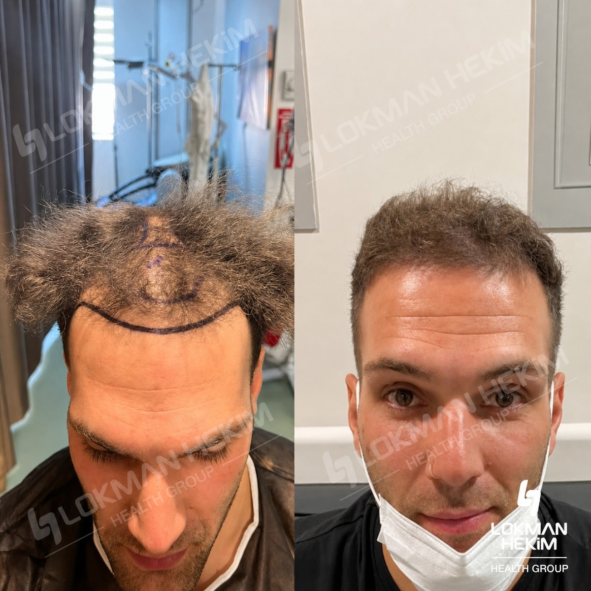 Before and after hair transplant results at Lokman Hekim Istanbul Hospital, restored hairline