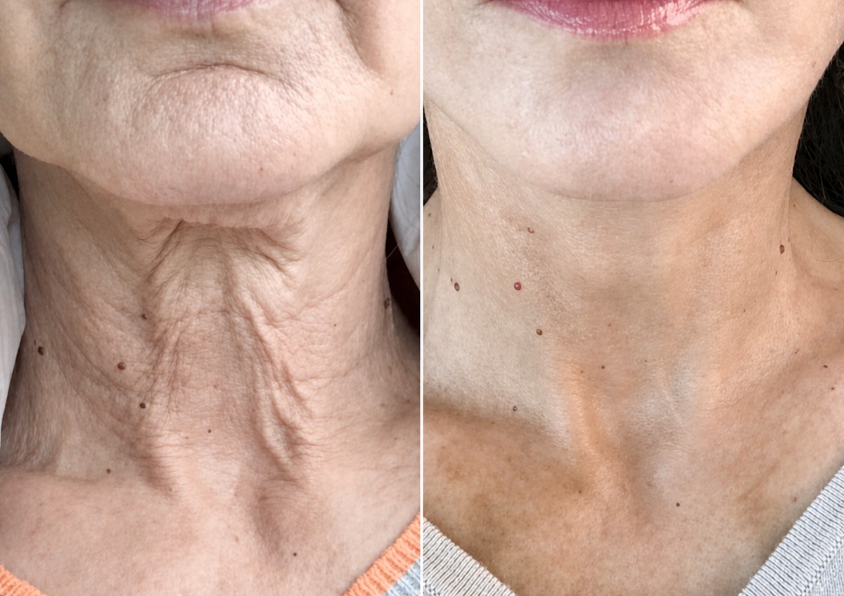 Результати підтяжки обличчя до і після в CE International Hospital – підтягнута шия